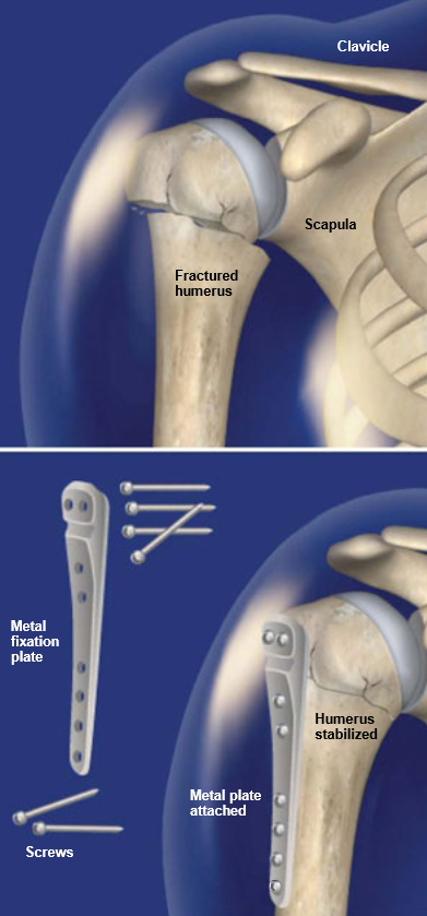 ORIF-Surgery.png